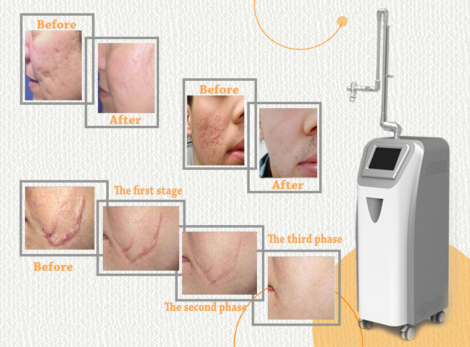 Dermatology Surgical Fractional Co2 Laser Scan And Cutting Device