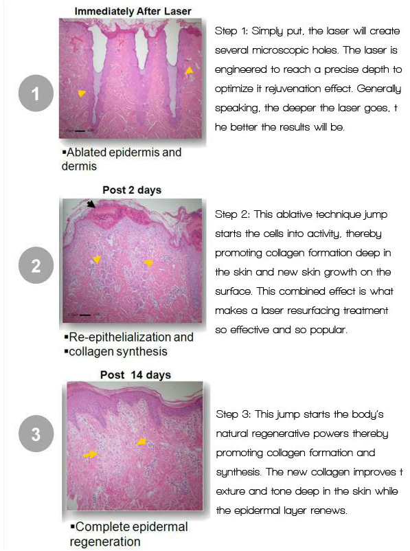CO2 Laser Skin Resurfacing Machine CO2 Laser Skin Resurfacing Machine