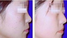 Co2 Laser Skin And Face Lifting Co2 Laser Skin And Face Lifting