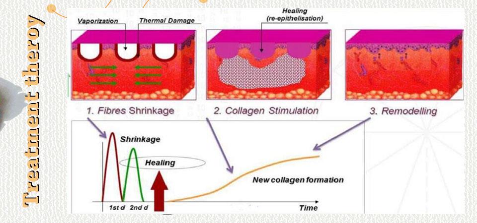 Co2 Laser Skin And Face Lifting Co2 Laser Skin And Face Lifting