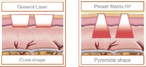 Radio Frequency Wrinkle Removal Radio Frequency Wrinkle Removal