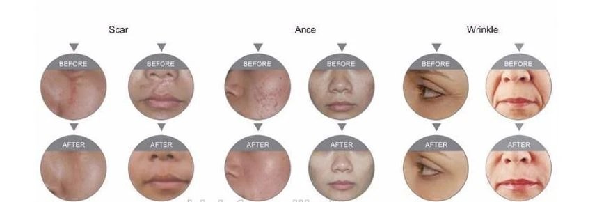 advanced fractional co2 laser machine for vaginal tightening and skin rejuvenation