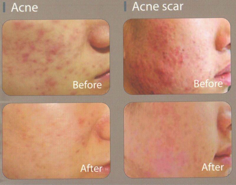 advanced fractional co2 laser machine for vaginal tightening and skin rejuvenation